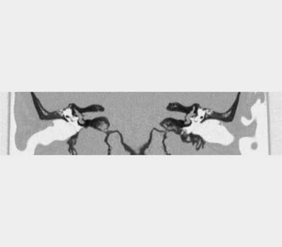 coupe scanner rocher coronal
