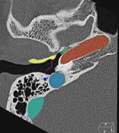 Coupe axiale passant par la partie p�treuse de l'art�re carotide interne