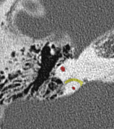 Coupe axiale passant par le canal semi-circulaire sup�rieur