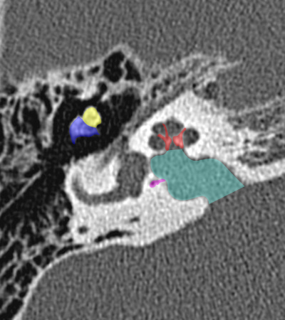 Coupe axiale passant par le modiolus de la cochl�e
