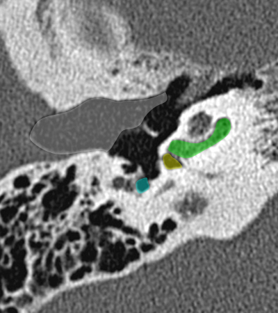 Coupe axiale passant par la fen�tre ronde