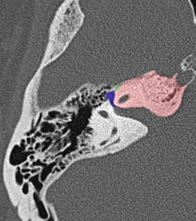 Coupe axiale passant par le ganglion g�nicul�