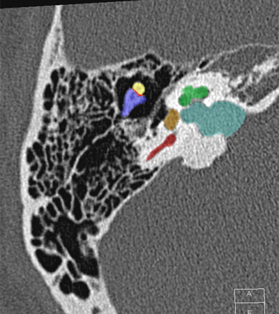 Coupe axiale passant par l'articulation incudo-mall�aire