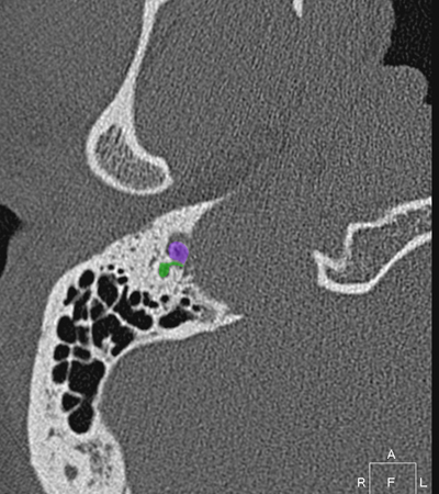 Coupe axiale passant par le foramen stylo�de
