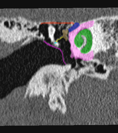 Coupe coronale passant par le muscle tenseur du tympan