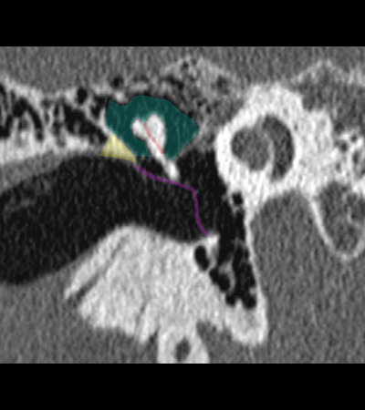 Coupe coronale passant par le recessus epitympanique
