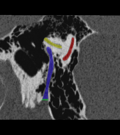 Coupe sagittale passant par le segment masto�dien du nerf facial