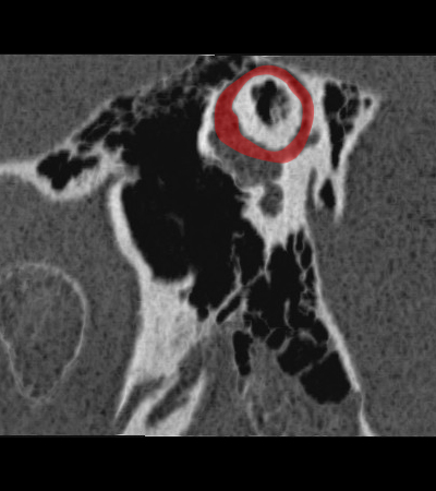 coupe sagitalle oblique passant par le canal semi-circulaire sup�rieur (plan de P�schl)