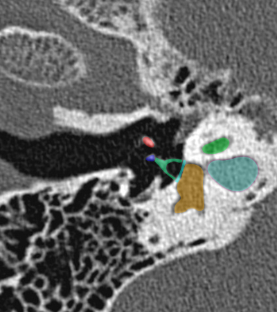Reconstruction axiale passant par le plan de l'�trier