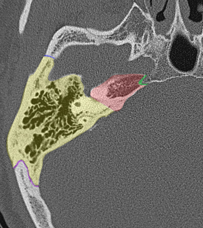 Coupe axiale passant par les apex p�treux