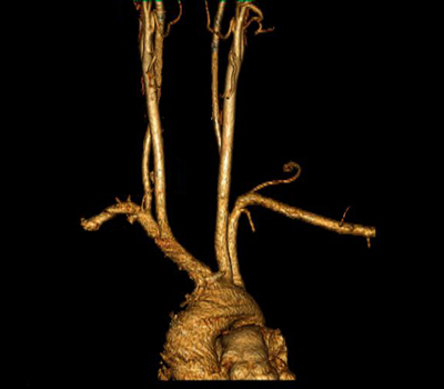 TDM sagittal