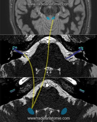 Radioanatomie des voies auditives centrales primaires en IRM avec tractographie