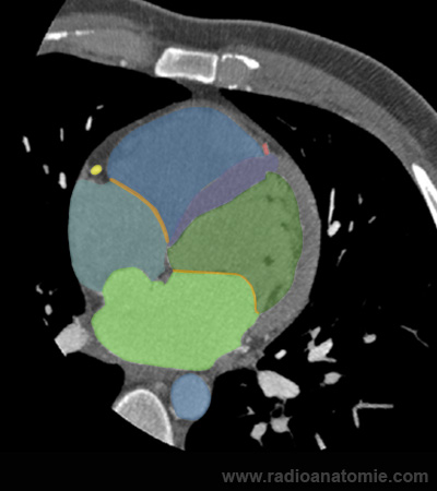 Radioanatomie du coeur sur coupes TDM