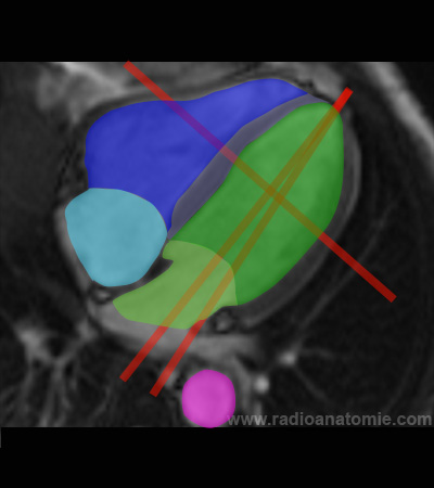 Radioanatomie et plans de coupe en IRM cardiaque