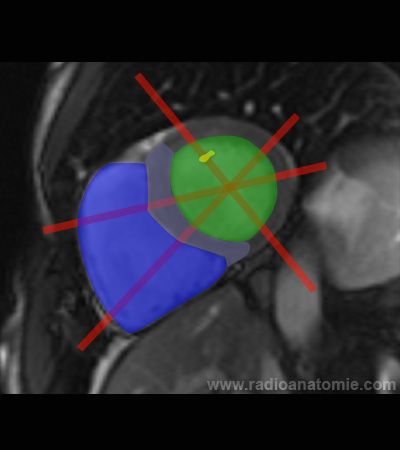 Radioanatomie et plans de coupe en IRM cardiaque